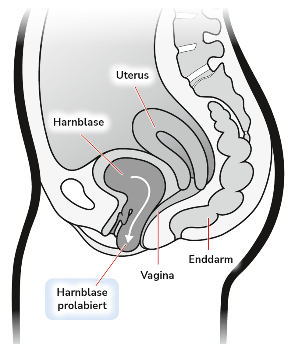 Urogyn Kologie Descensus Genitalis